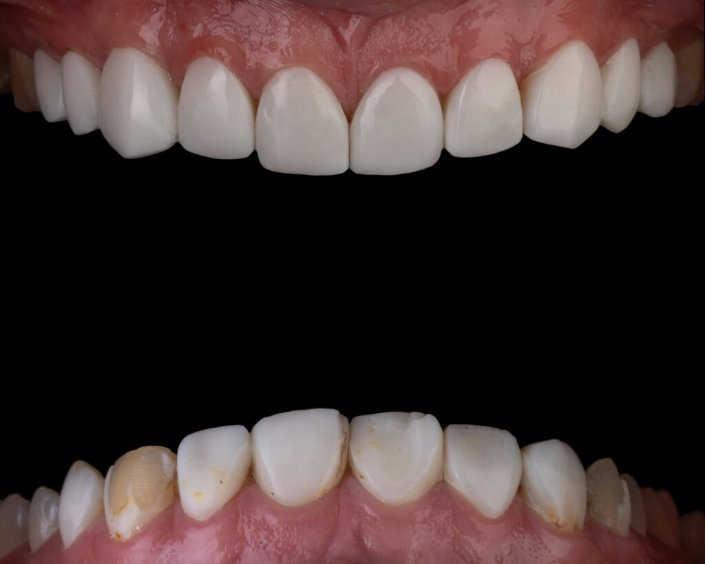 How Much to Fix a Chipped Tooth? guide to chipped tooth repair, dental bonding, veneers, crowns, pricing factors, and treatment results.