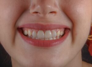 How Much to Fix a Chipped Tooth? Proven Treatment Options, Costs & Results