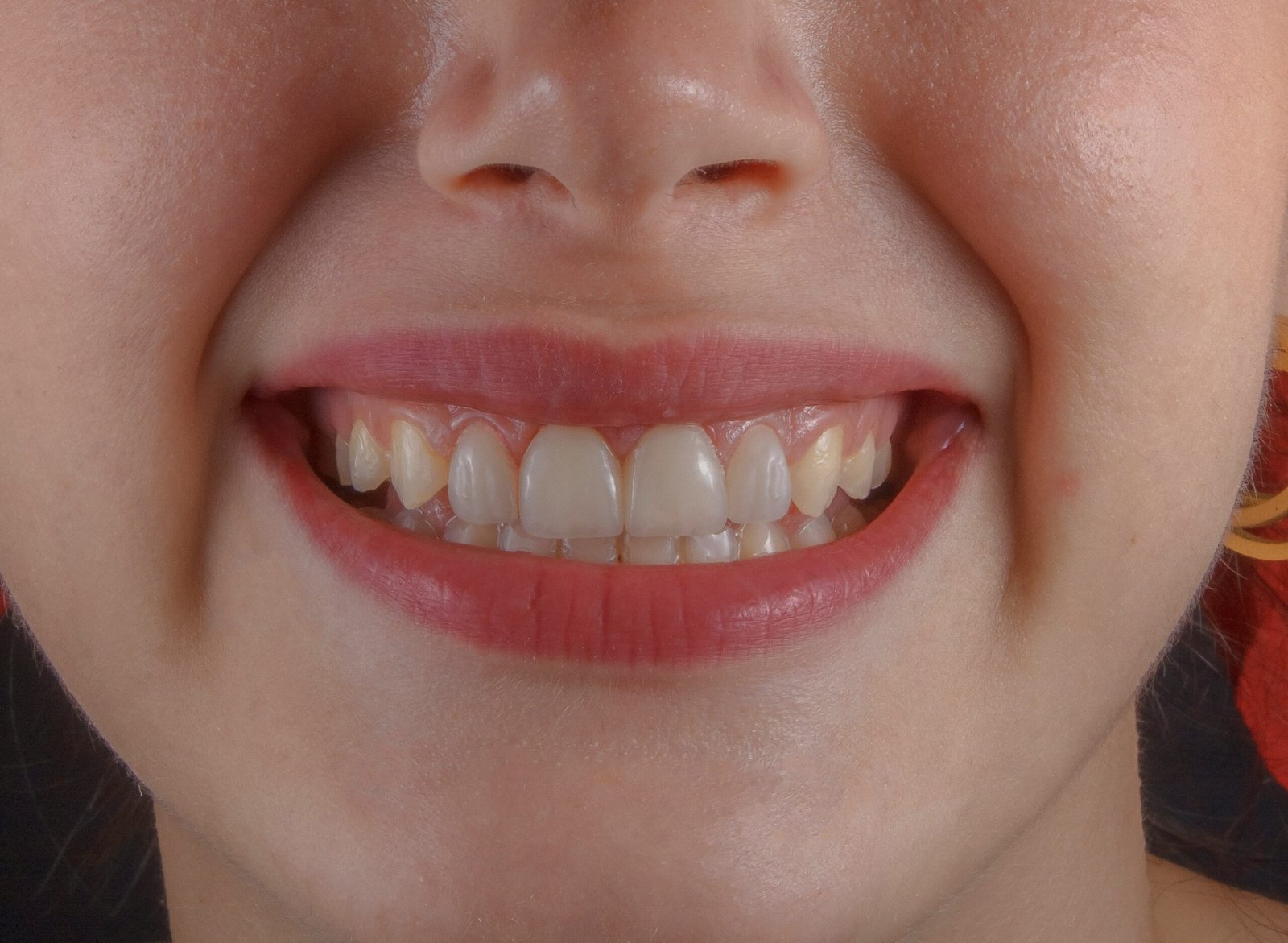 How Much to Fix a Chipped Tooth? featuring dental bonding, veneers, crowns, repair costs, treatment options, and expected results.