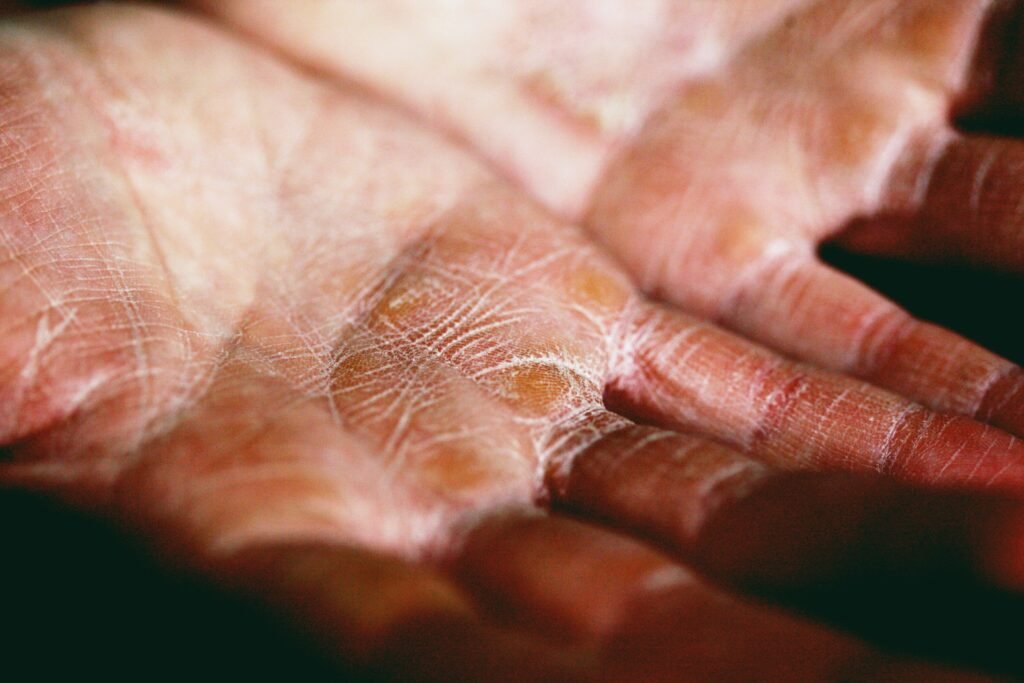 Why Is the Skin on My Hands Peeling? Common Causes, Warning Signs & Treatment Tips covering dry hands, peeling skin, eczema, allergies, irritation, and treatment methods.